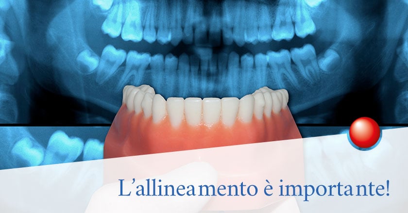 Cos'è la Malocclusione e come si risolve